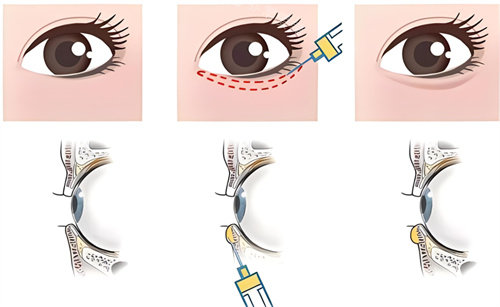 郑州王杨医生做卧蚕怎么样?王杨卧蚕修复技术好！重塑灵动双眸，个性化方案解决僵硬不对称问题！
