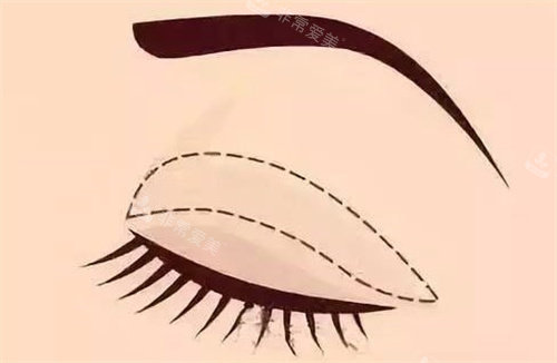 全切双眼皮 全切双眼皮