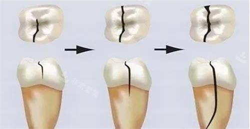 牙齿裂纹的发展过程