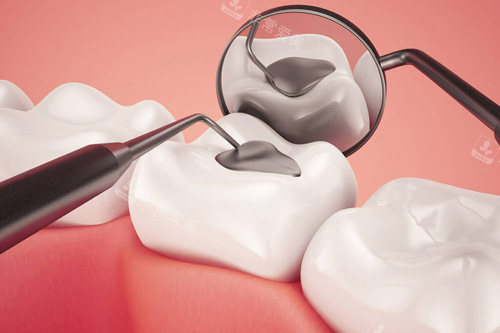 牙齿嵌体示意图