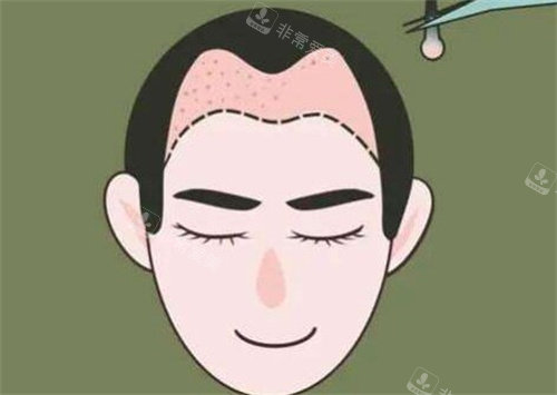 韩国ID整形医院朴喜宰怎么样？2%专门医亲诊，拯救发际线秃顶，头皮毛囊养护口碑较好