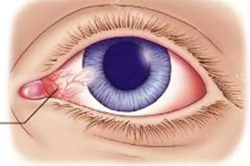 翼状胬肉卡通图