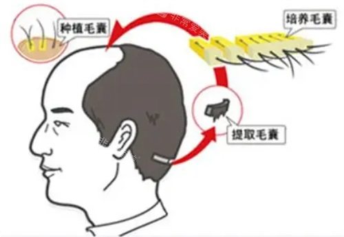 南宁植发多少钱3000单位？2026价格表出炉，从FUE到不剃发技术收费解析，本土植发定价特点揭秘