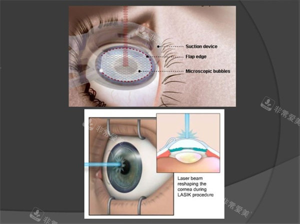近视眼手术照片