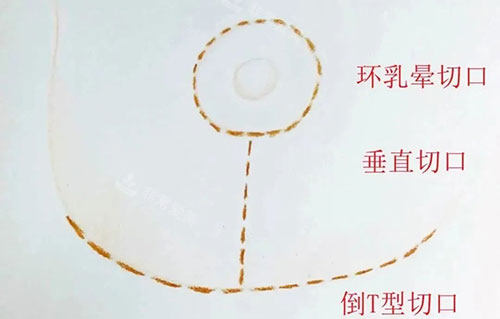 丰胸手术胸部下垂提升倒T字法