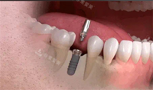 种植牙操作模型图片