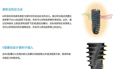 韩国沃兰种植牙优势图片