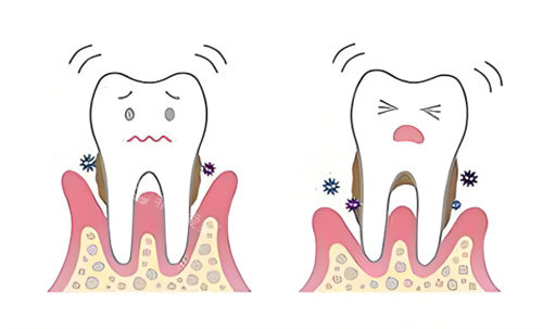 牙周炎卡通图片