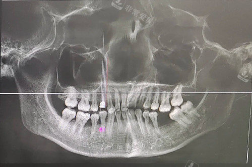 牙周炎 牙龈萎缩 缺牙