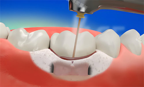 牙周炎激光治疗