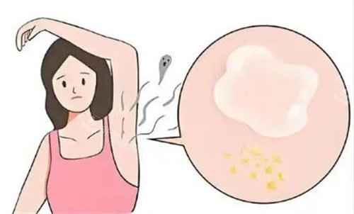 西安新城仁爱皮肤医院去狐臭技术好不好？激光+小切口双技术，无痕除味口碑超赞