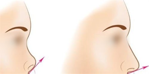 隆鼻手术鼻尖角度调整前后对比图