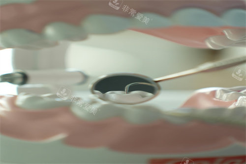 牙齿治疗细节展示