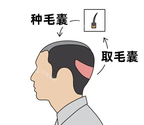 毛发移植卡通图片