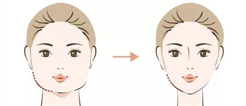 瘦脸手术前后对比动画图 瘦脸手术前后对比动画图