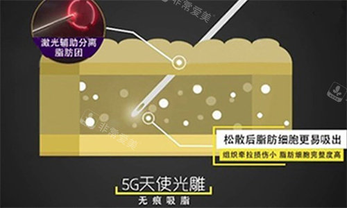 5G天使光雕吸脂 5G天使光雕吸脂