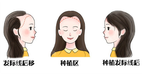 芜湖曙光植发医院是正规吗?口碑怎么样？是芜湖正规植发医院且收费不贵！