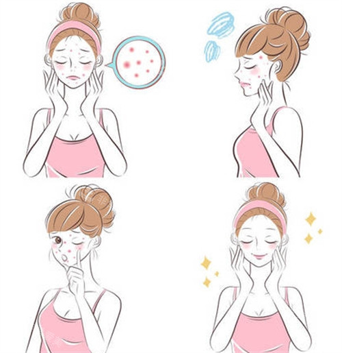 祛痘治疗过程 祛痘治疗过程