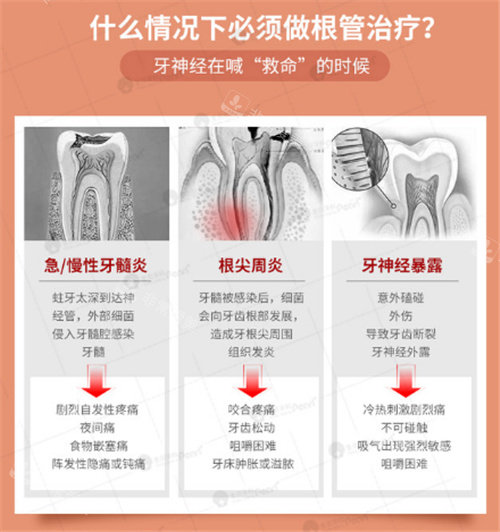 适合做根管治疗的情况