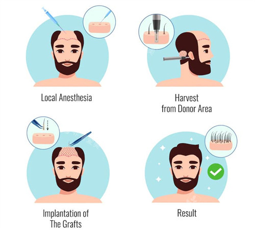 植发手术过程图一览