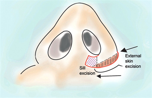 改善鼻孔大小不同