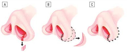 鼻孔大小不一样