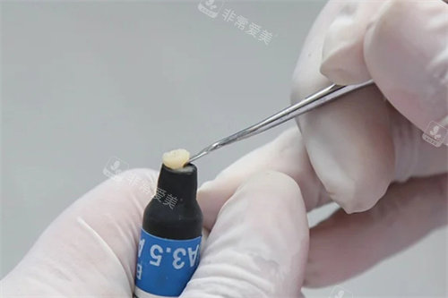 医生取补牙树脂