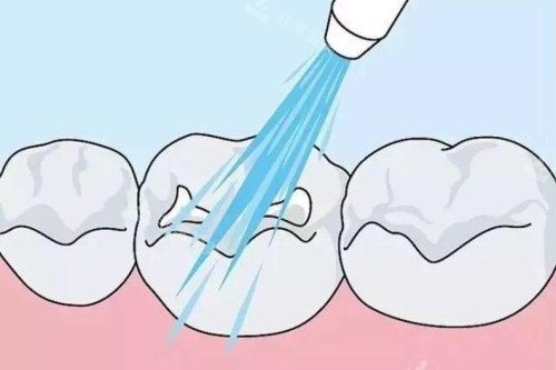 儿牙涂氟卡通图
