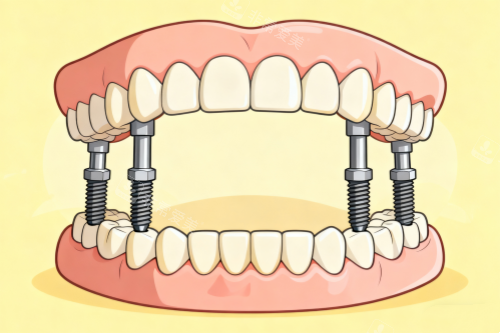 全口种植牙一览