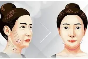 面部提升术 面部提升术