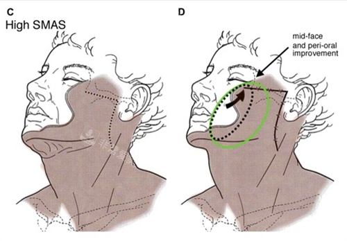 狎鸥亭激光抗衰好的机...