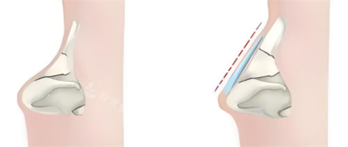 隆鼻超肋材料对比 隆鼻超肋材料对比