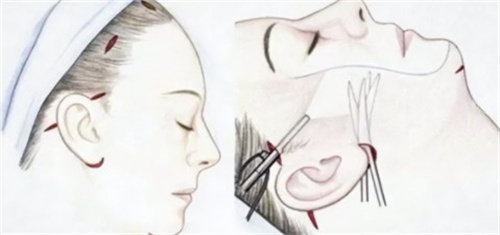 2026冯国平小拉皮手术...