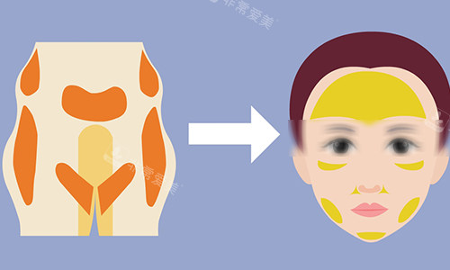 脂肪填充动画图 脂肪填充动画图