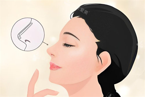 假体隆鼻卡通图 假体隆鼻卡通图