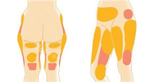 首尔变形记：我的腰腹+大腿吸脂全记录，痛并蜕变的28天