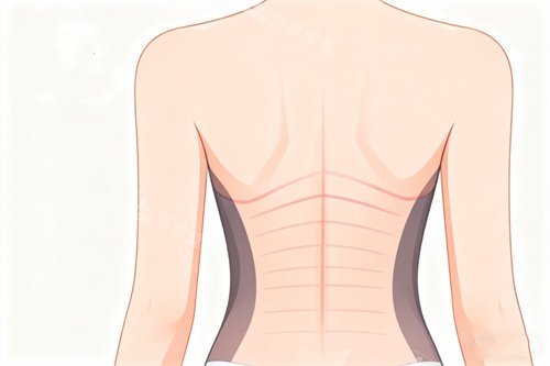 背部吸脂塑形卡通图 背部吸脂塑形卡通图