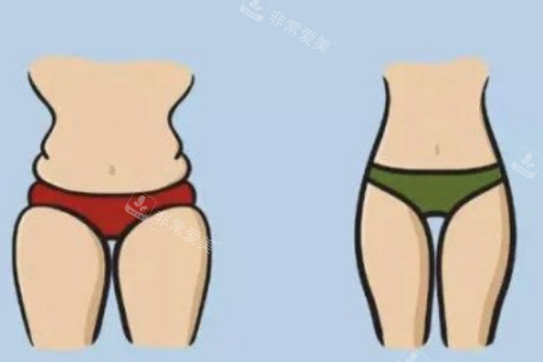 腿部吸脂对比图 腿部吸脂对比图