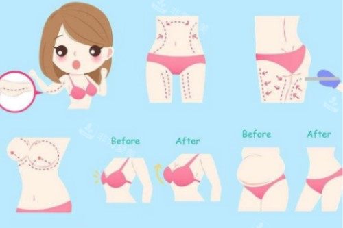 吸脂塑形卡通概念图 吸脂塑形卡通概念图