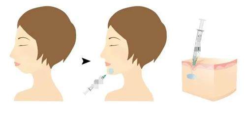韩国ksy皮肤科怎么样？正规资质皮肤科，打玻尿酸/光电抗衰受认可
