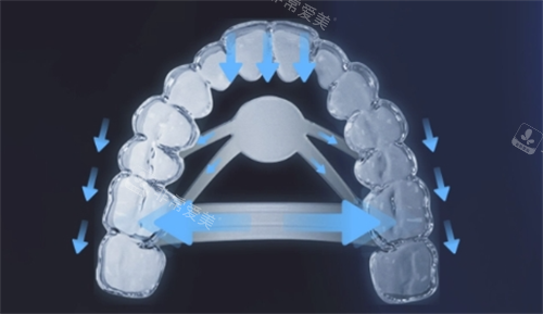 正雅隐形矫正s11牙齿位移变化