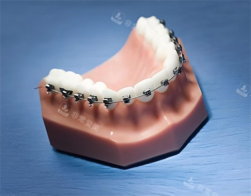 牙齿矫正模型展示图片