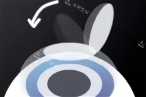 半飞秒盖回角膜瓣