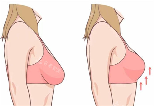 广州华美郝永生的胸下垂矫正技术怎么样？二十余年经验，术式自然挺拔