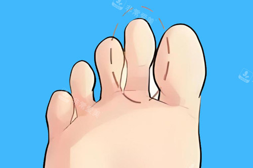 二脚趾长卡通图