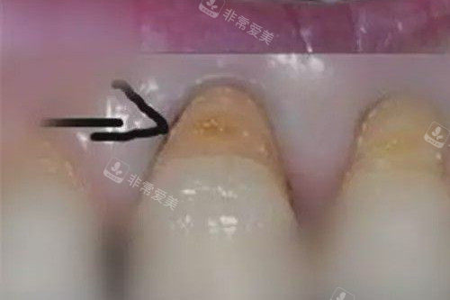 牙齿楔状缺损照片
