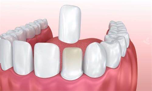 牙贴面动画展示图 牙贴面动画展示图