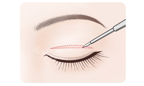 全切双眼皮切口展示 全切双眼皮切口展示