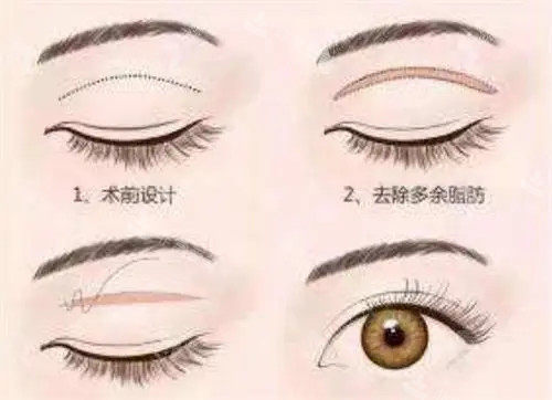 全切双眼皮卡通示意图 全切双眼皮卡通示意图