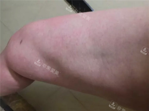 吸脂凹凸不平图示